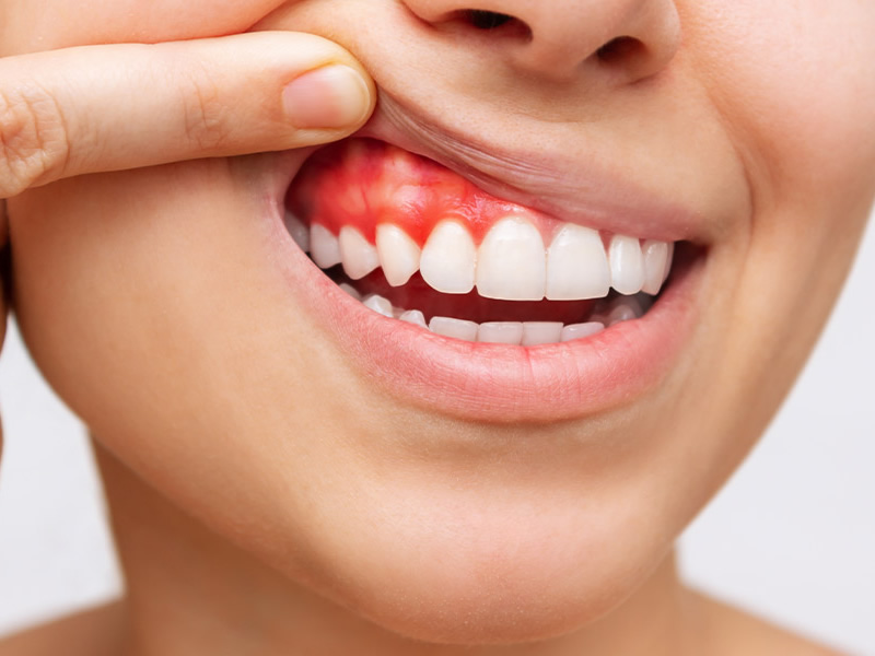 Diş Eti Hastalıkları