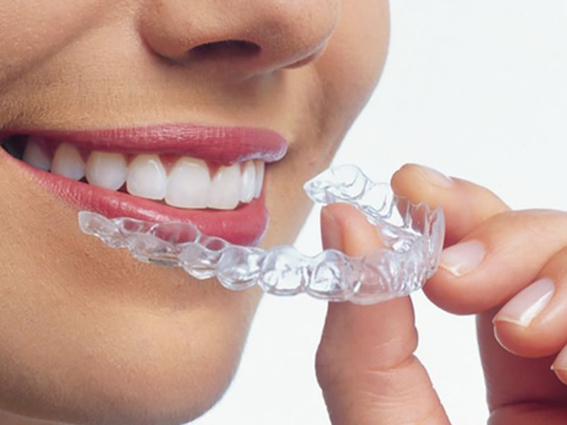 Şeffaf Plak (Invisalign)