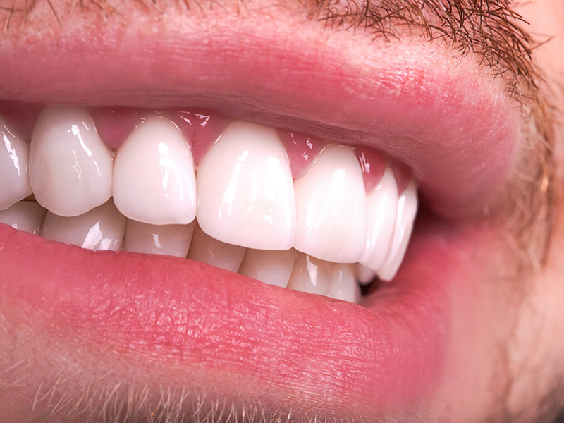 Zirkonyum Diş Kaplama